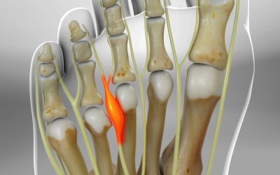 Neuroma de Morton: o que é e como podemos ajudar?